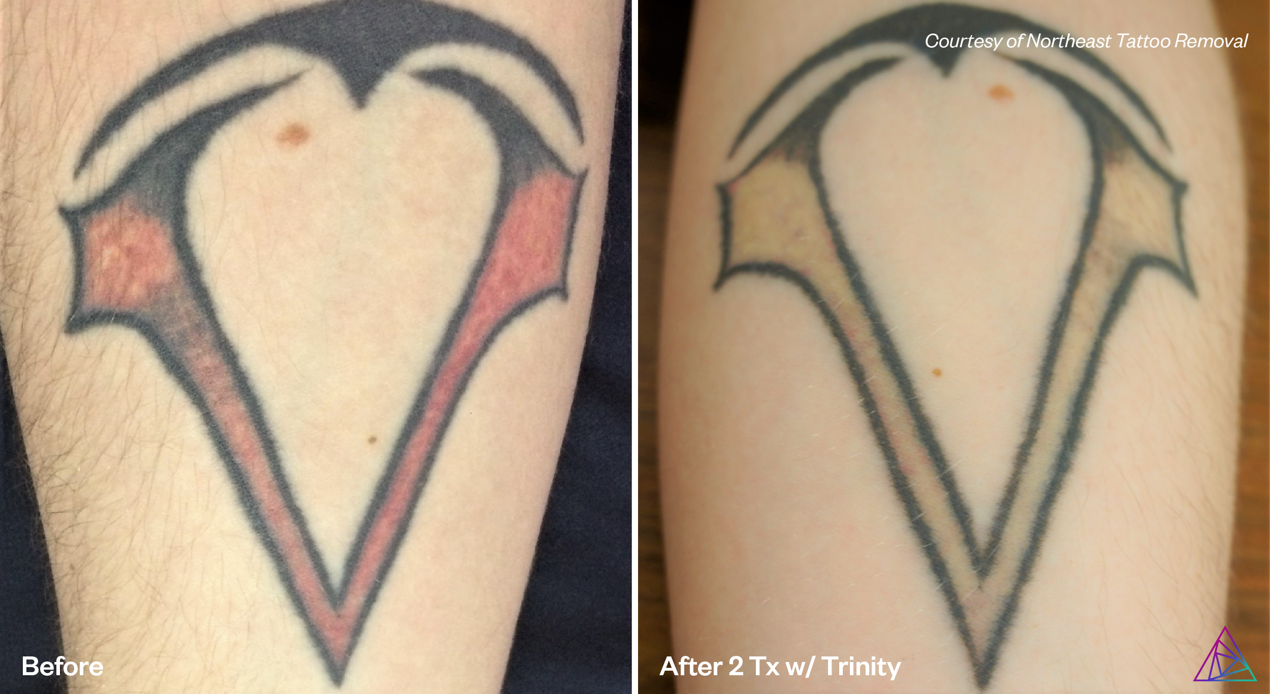 Before and after tattoo removal